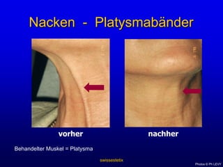 swissestetixBrauenliftvorhernachher