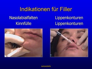 swissestetixKrähenfüssenachhervorher