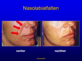 swissestetixBehandlung statischer FaltenUnterspritzung mit FillerFaltenreduktion durch Ersatz von natürlicherweise verloren gegangenem Volumen