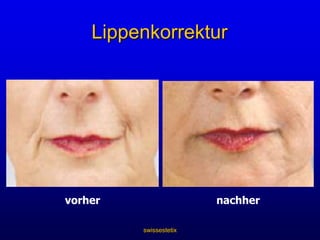 Korrektur der Wangefülle, Kieferknochen und Kinn-partie