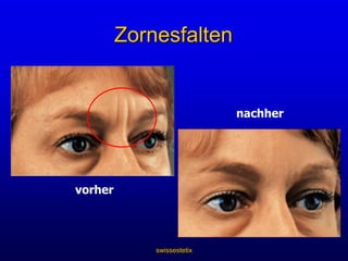 swissestetixNasolabialfaltenvorhernachher