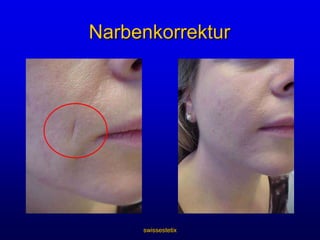 swissestetixNasolabialfaltenvorhernachher