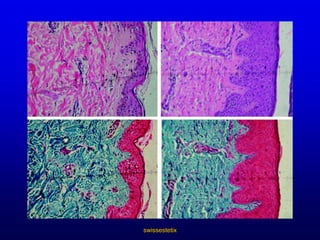 swissestetixNasolabialfaltennachhervorher