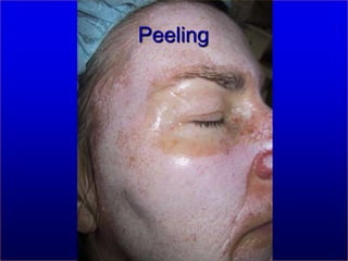 swissestetixLippenkorrekturvorhernachher