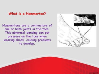 Normal Toe Bend Have a hammertoe..? | PDF