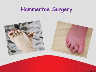 Hammertoe Surgery
 