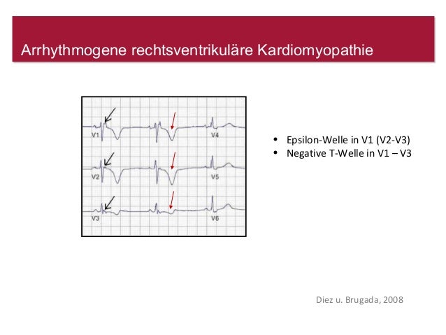 Ekg Was Sie Nicht Ubersehen Sollten Www Fokus Ekg De