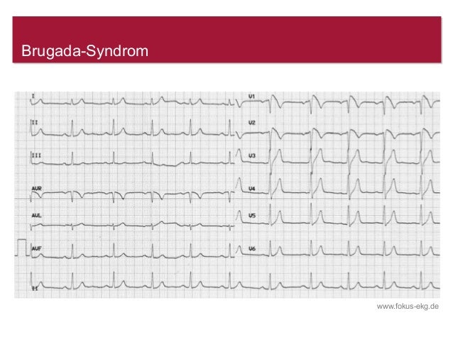 Was Sie Schon Immer Uber Das Ekg Wissen Wollten Www Fokus Ekg De