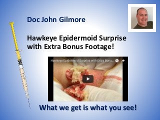 Hawkeye Epidermoid Surprise
with Extra Bonus Footage!
What we get is what you see!
Doc John Gilmore
 