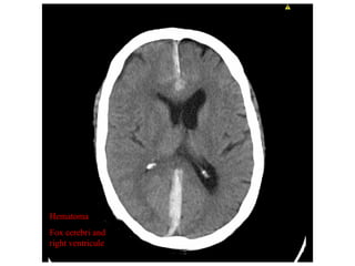 Hematoma
Fox cerebri and
right ventricule
 