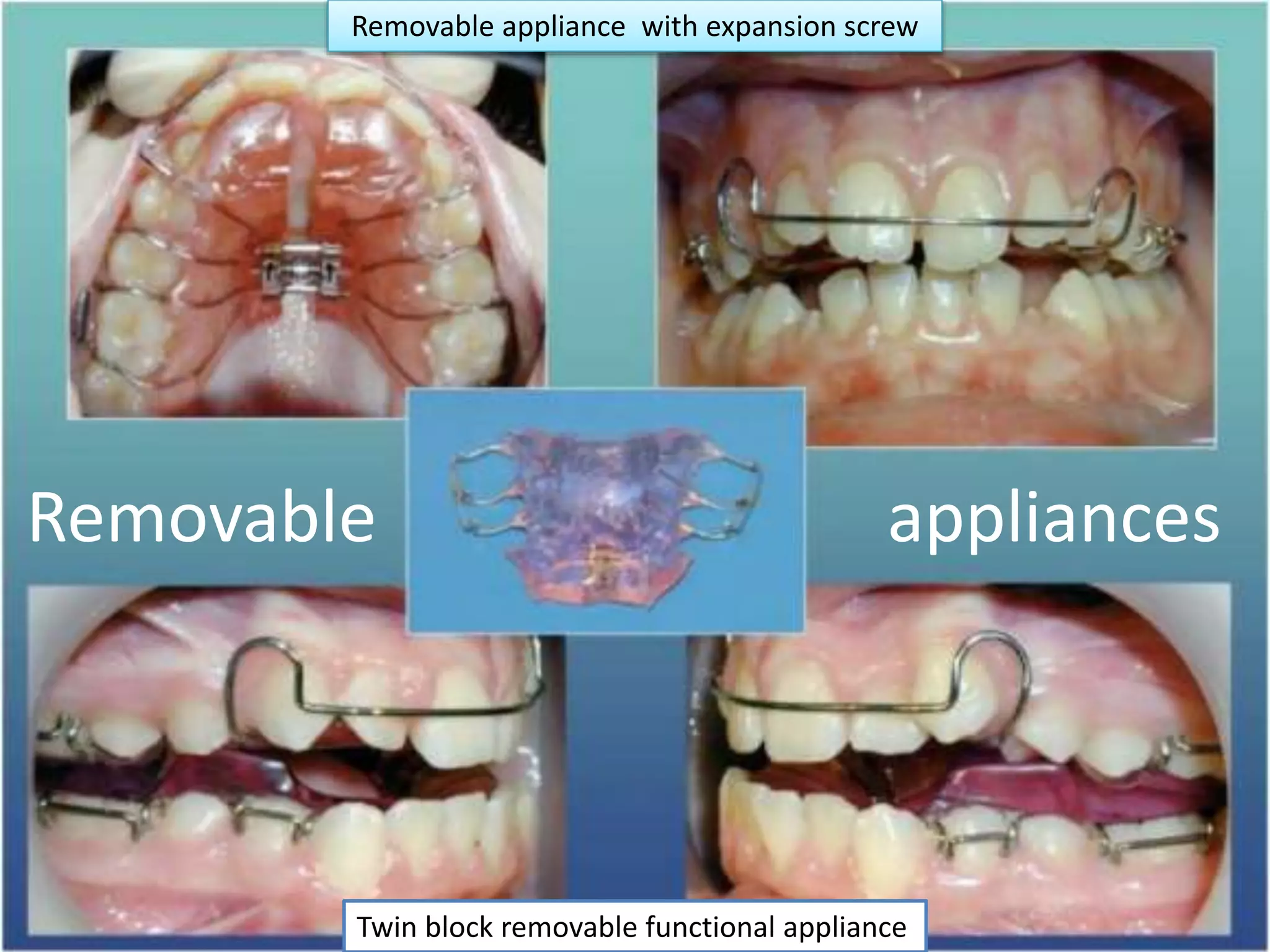 Hazards of swallowing orthodontic appliances PPT