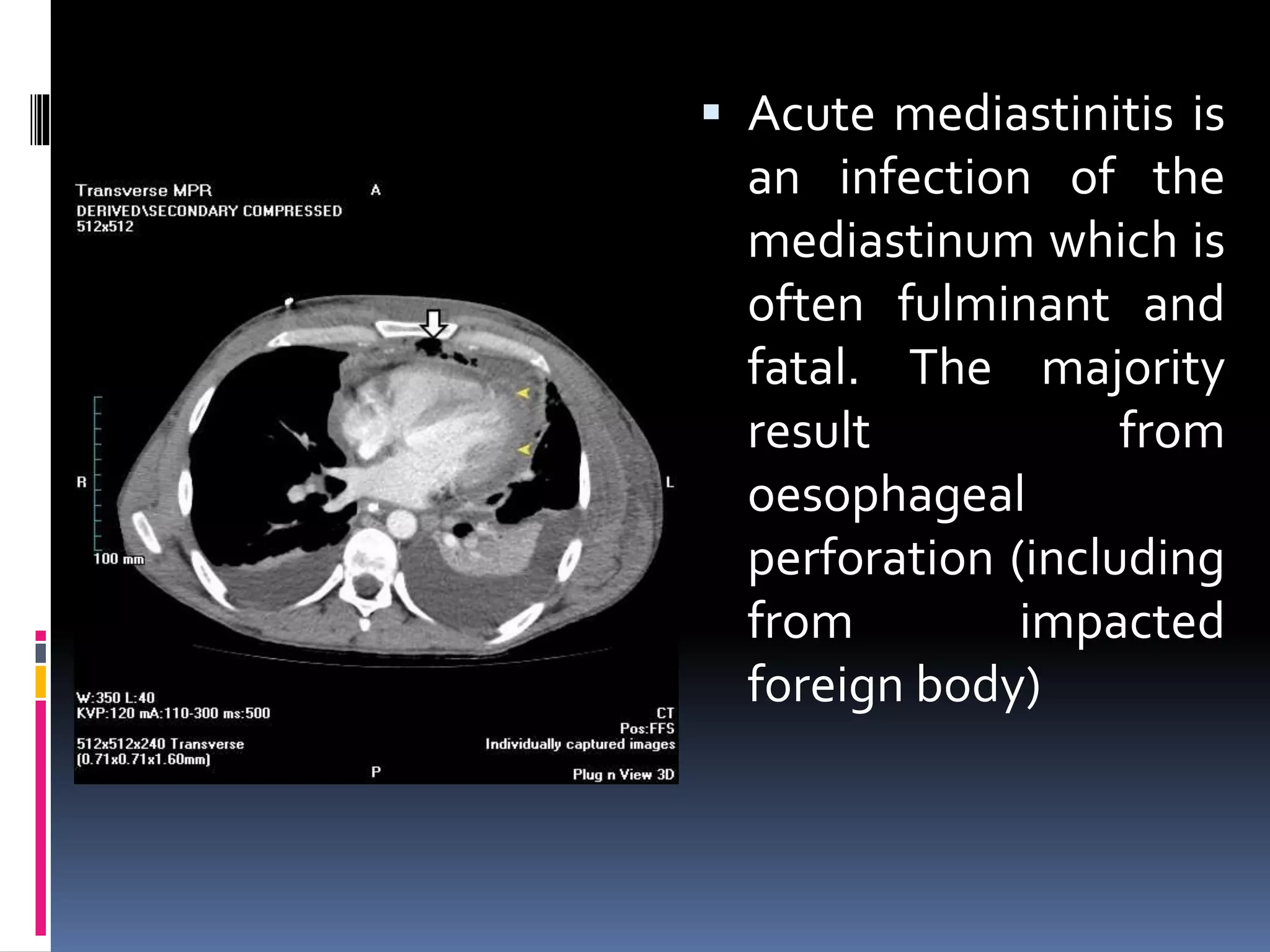 Hazards Of Swallowing Orthodontic Appliances PPTX