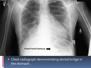 Hazards of swallowing orthodontic appliances | PPTX
