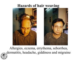 Hazards of hair weaving
Allergies, eczema, errythema, seborrhea,
dermatitis, headache, giddiness and migraine
 