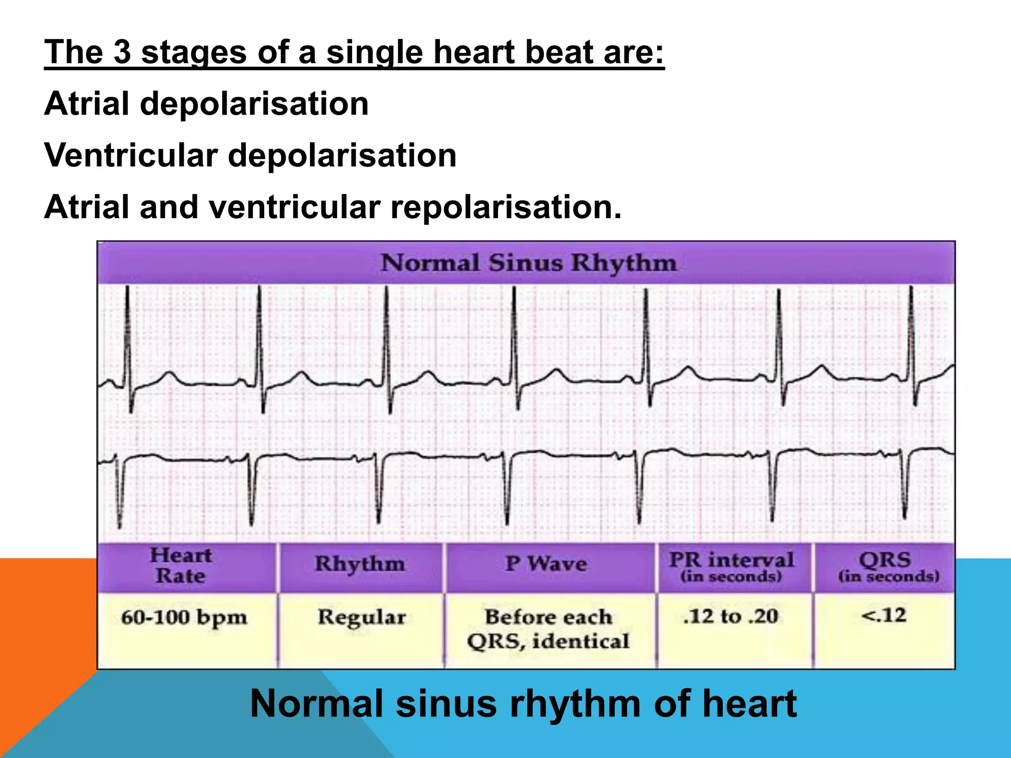 The 3 stages of a single heart beat are:
Atrial depolarisation
Ventricular depolarisation
Atrial and ventricular repolarisation.
Normal sinus rhythm of heart
 