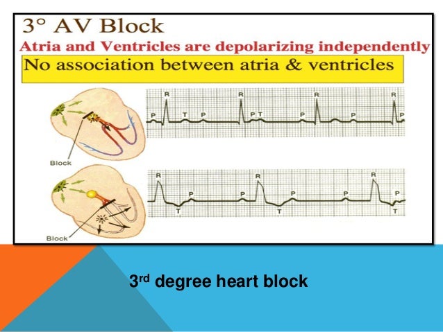Heart Block With Nursing Management Heart Block With Nursing Management