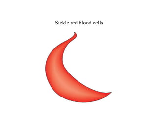 Sickle red blood cells
 