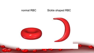 normal RBC Sickle shaped RBC
Dr.N.Sivaranjani
 