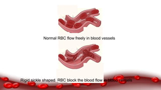 Normal RBC flow freely in blood vessels
Rigid sickle shaped RBC block the blood flow in blood vessels
Dr.N.Sivaranjani
 