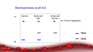 Point of application
+
Electrophoresis at pH 8.6
HbA
HbS
Normal Sickle cell
trait
Sickle cell
anemia
Dr.N.Sivaranjani
 