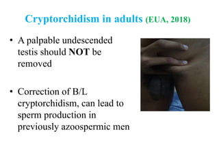 Cryptorchidism in adults (EUA, 2018)
• A palpable undescended
testis should NOT be
removed
• Correction of B/L
cryptorchidism, can lead to
sperm production in
previously azoospermic men
 