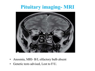 Pituitary imaging- MRI
• Anosmia, MRI- B/L olfactory bulb absent
• Genetic tests advised, Lost to F/U.
 