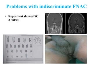 Problems with indiscriminate FNAC
• Repeat test showed SC
2 mil/ml
 