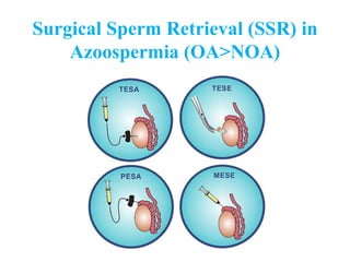 Surgical Sperm Retrieval (SSR) in
Azoospermia (OA>NOA)
 