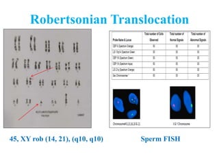 Robertsonian Translocation
45, XY rob (14, 21), (q10, q10) Sperm FISH
 