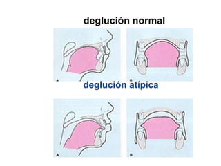 deglución normal
deglución atípica
 