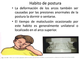 Habito de postura
• La deformación de los arcos también ser
causadas por las presiones anormales de la
postura la dormir o sentarse.
• El tiempo de maloclusión ocasionado por
este habito es generalmente unilateral o
localizado en el arco superior.
 