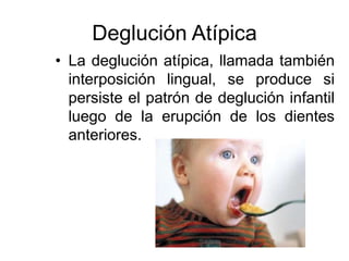 Deglución Atípica
• La deglución atípica, llamada también
interposición lingual, se produce si
persiste el patrón de deglución infantil
luego de la erupción de los dientes
anteriores.
 