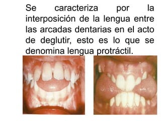 Se caracteriza por la
interposición de la lengua entre
las arcadas dentarias en el acto
de deglutir, esto es lo que se
denomina lengua protráctil.
 