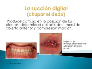 Produce cambio en la posición de los
dientes, deformidad del paladar, mordida
abierta anterior y compresión maxilar .
Oclusión normal
lengua baja
mordida abierta anterior
alteración del cierre
bucal
 
