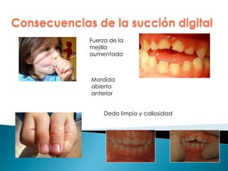 Fuerza de la
mejilla
aumentada
Dedo limpio y callosidad
Mordida
abierta
anterior
Consecuencias de la succión digital
 