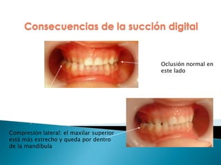 Compresión lateral: el maxilar superior
está más estrecho y queda por dentro
de la mandíbula
Oclusión normal en
este lado
Consecuencias de la succión digital
 