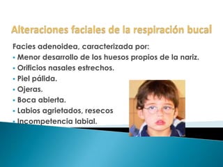 Facies adenoidea, caracterizada por:
 Menor desarrollo de los huesos propios de la nariz.
 Orificios nasales estrechos.
 Piel pálida.
 Ojeras.
 Boca abierta.
 Labios agrietados, resecos
 Incompetencia labial.
 