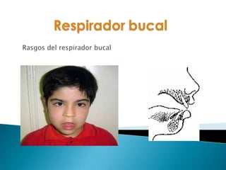 Rasgos del respirador bucal
 