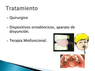  Quirurgico
 Dispositivos ortodóncicos, aparato de
disyunción.
 Terapia Miofuncional.
 