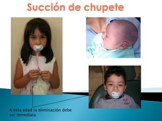 Succión de chupete
A esta edad la eliminación debe
ser inmediata
 