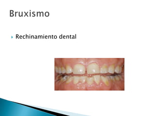  Rechinamiento dental
 
