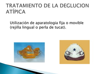 Utilización de aparatologia fija o movible
(rejilla lingual o perla de tucat).
 
