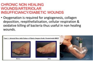 CHRONIC NON HEALING
WOUNDS/ARTERIOLAR
INSUFFICIANCY/DIABETIC WOUNDS
• Oxygenation is required for angiogenesis, collagen
deposition, reepithelialisation, cellular respiration &
oxidative killing of bacteria thus useful in non healing
wounds.
 