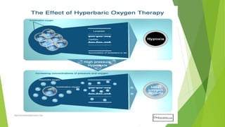 Hyperbaric oxygen therapy | PPTX