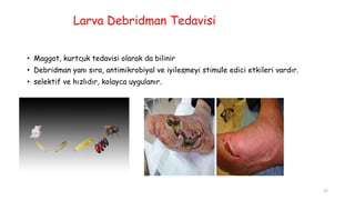 Larva Debridman Tedavisi
• Maggot, kurtçuk tedavisi olarak da bilinir
• Debridman yanı sıra, antimikrobiyal ve iyileşmeyi stimüle edici etkileri vardır.
• selektif ve hızlıdır, kolayca uygulanır.
37
 