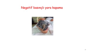 Negatif basınçlı yara kapama
38
 