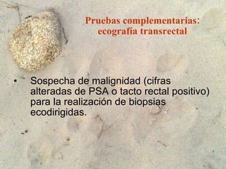 Pruebas complementarias: ecografía transrectal Sospecha de malignidad (cifras alteradas de PSA o tacto rectal positivo) para la realización de biopsias ecodirigidas. 