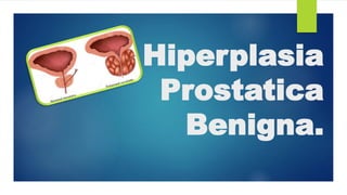 Hiperplasia
Prostatica
Benigna.
 
