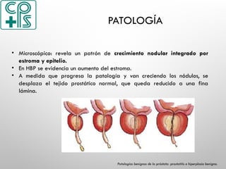 PATOLOGÍA
• Microscópico: revela un patrón de crecimiento nodular integrado por
estroma y epitelio.
• En HBP se evidencia un aumento del estroma.
• A medida que progresa la patología y van creciendo los nódulos, se
desplaza el tejido prostático normal, que queda reducido a una fina
lámina.
Patologías benignas de la próstata: prostatitis e hiperplasia benigna.
 
