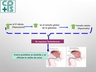 Uretra prostática se estreche y se
dificulte la salida de orina.
en el # células
(Hiperplasia)
en el tamaño global
de la glándula.
tamaño celular
(Hipertrofia)
Se requiere Testosterona
FISIOPATOLOGÍA
 
